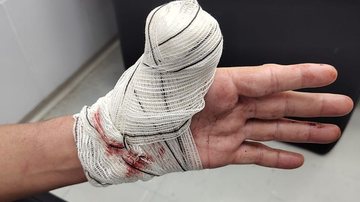 Homem descobriu no hospital que havia perdido parte do dedo - Imagem: Mongagua litoral