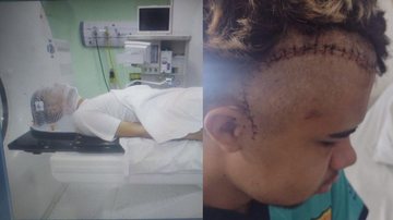 Jovem passou por microcirurgia e retirou parte do tumor - Imagens/arquivo pessoal
