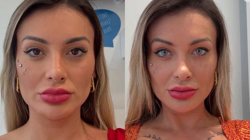 Influencers popularizam cirurgia nos olhos que pode causar glaucoma e cegueira