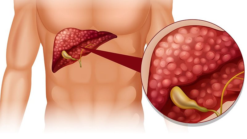 Imagem ilustrativa do fígado com gordura