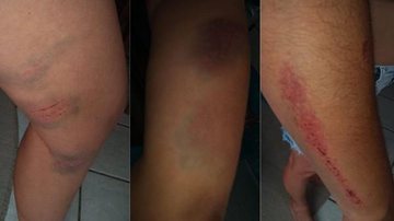 Imagem Mulher é espancada com pá pelo ex e leva mais de 40 pontos na cabeça