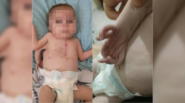 Cesar nasceu em Praia Grande, com metade do coração e três braços Bebê de Praia Grande com três braços - Foto: reprodução / web