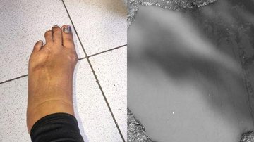 Cratera no Guarujá faz vítima e termina em desastre - Reprodução/Redes Sociais
