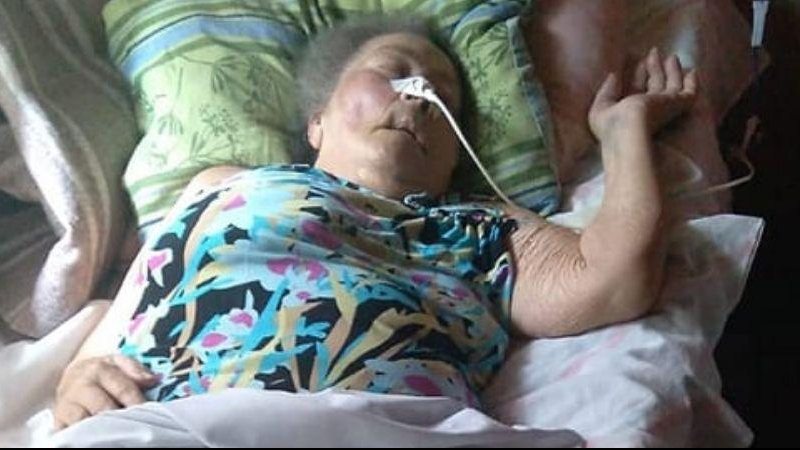 Moradora de Praia Grande necessita de itens básicos e hospitalares Familiares pedem doação para idosa acamada Foto da idosa acamada, dormindo e com aparelho no rosto - Hanna Alves