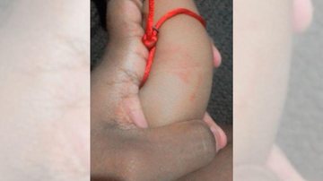 Menino ficou com marcas nos braços por conta do atrito com o portão, mas passa bem e está com a mãe Bebê de 1 ano quase é furtando enquanto brincava no quintal de casa Braços da criança com arranhões - Reprodução Facebook