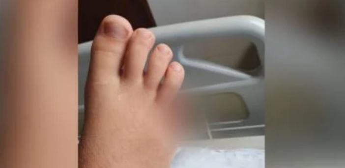 Vítima te e o dedo mínimo do pé amputado Menino é atacado por piranha e tem o dedo amputado Pé do menino após acidente - Arquivo pessoal