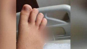 Vítima te e o dedo mínimo do pé amputado Menino é atacado por piranha e tem o dedo amputado Pé do menino após acidente - Arquivo pessoal