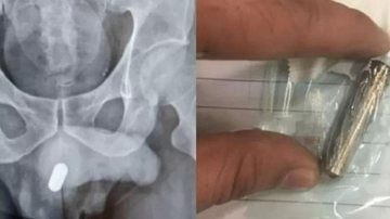 Para retirar a pilha sem prejudicar o órgão genital, foi necessário abrir o períneo - tecido entre o saco escrotal e o ânus Com pilha dentro do pênis, homem vai parar no hospital Foto do raio-x com a pilha dentro do corpo e outra foto da pilha dentro de sa - Reprodução