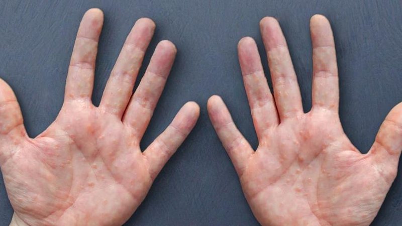 A doença não é contagiosa e nem transmissível Disidrose Mãos com bolhas vermelhas - Divulgação