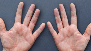 A doença não é contagiosa e nem transmissível Disidrose Mãos com bolhas vermelhas - Divulgação