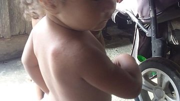 Durante o parto, o bebê teve dificuldade na passagem pela pelve da mãe Criança nasce com clavícula quebrada após maus-tratos de médico durante o parto, em Bertioga Criança de lado, mostrando o braço que não consegue esticar e o osso saltado nas costas - Arquivo pessoal