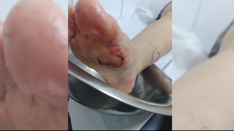 Vítima publicou essa foto assim que tiraram o projetil de seu pé machucado Tiro no pé Pé machucado no hospital - Arquivo Pessoal