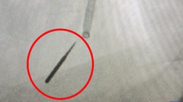 Radiografia do pulmão de Jozsi capa - Americano vai ao dentista e inala broca de uma polegada Raio-x de pulmão com broca de uma polegada - Imagem: Reprodução / WISN-TV