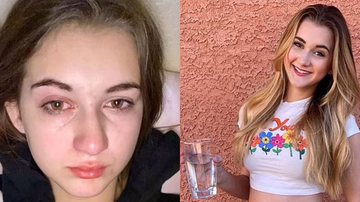 Sem poder chorar ou tomar banho, adolescente descobre ser alérgica à água - Reprodução Daily Mail
