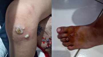 Moradora publicou foto dos jovens com ferimentos infeccionados e pus após brincarem na areia da praia - Reprodução/Facebook