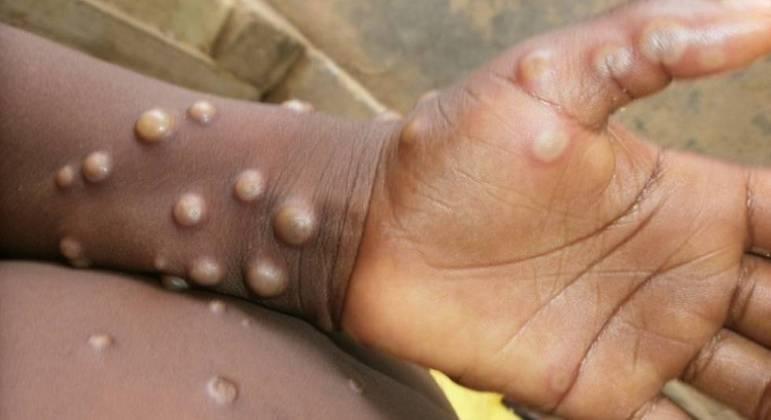 Portugal e Espanha contam com mais de 20 casos da doença cada país Varíola Homem com bolhas d'água na mão e no braço - Imagem Ilustrativa
