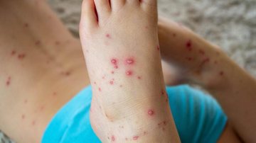 Doença traz bolhas dolorosas ao contaminado além de erupções vermelhas pela pele Gripe do tomate Pé de uma criança cheio de bolhas - Divulgação