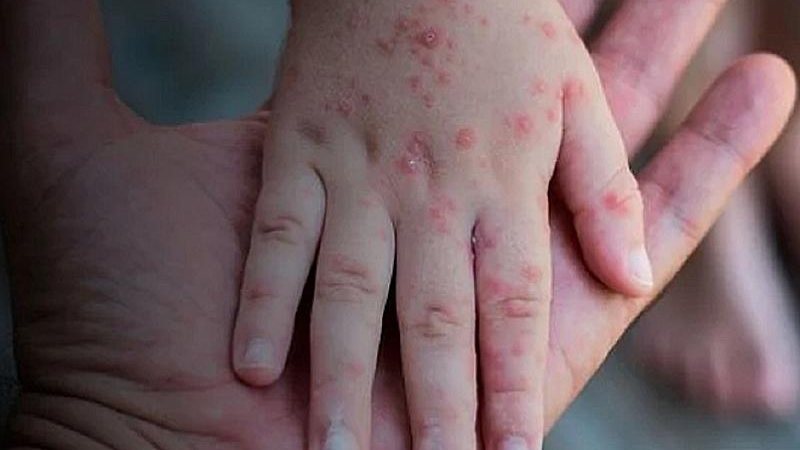 O arquipélago de Ilhabela confirmou o primeiro caso de Monkeypox (Varíola dos Macacos) no município Monkeypox: Ilhabela confirma primeiro caso de varíola dos macacos maos com pintas vermelhas - Foto: Divulgação/Reprodução