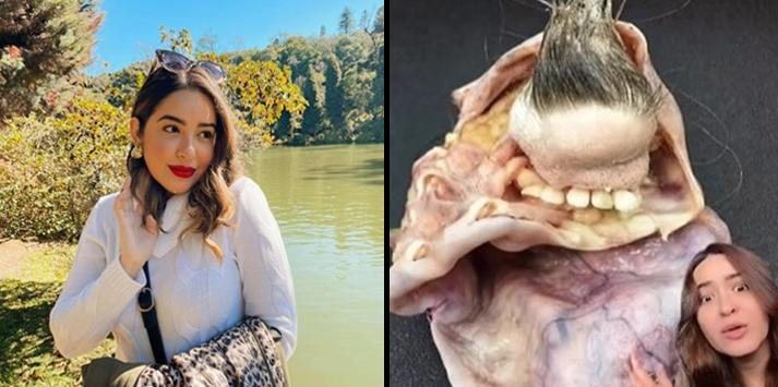 Teratoma de Drielly estava em seu ovário e tinha fios de cabelo e dentes - Reprodução/Internet