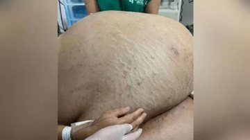 Mulher pesava 150kg com 1,45m de altura; tumor de 4kg foi retirado e a paciente permanece em recuperação Barriga com tumor Barriga com 46kg de tumor - Reprodução