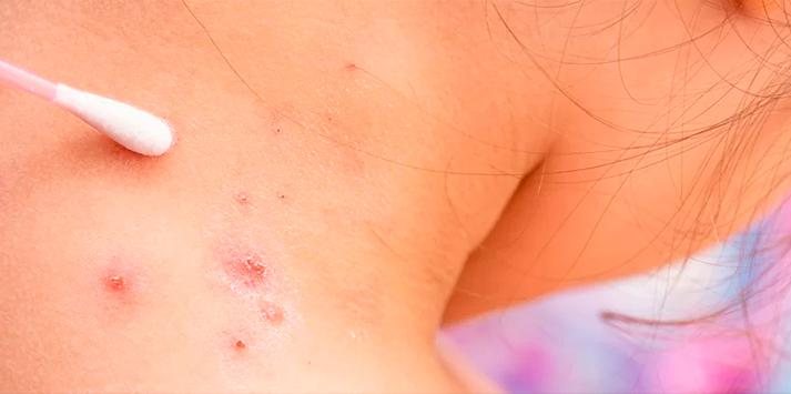 Brasil registra 76 novo casos da doença contagiosa Varíola do macaco - Imagem: Shutterstock