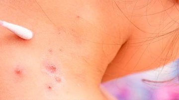 Brasil registra 76 novo casos da doença contagiosa Varíola do macaco - Imagem:  Shutterstock