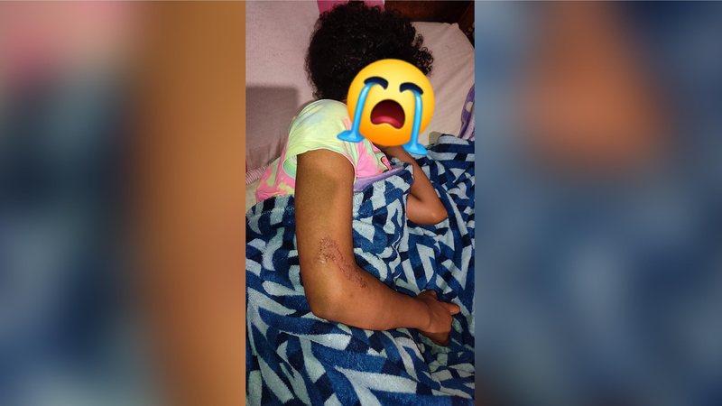 Criança mostra hematomas no braço direito após ser agredida na escola, em São Sebastião Criança é agredida por outras quatro alunas dentro do banheiro de escola municipal em São Sebastião (SP) Criança mostra hematomas no braço direito após ser agredida na  - Foto: Divulgação