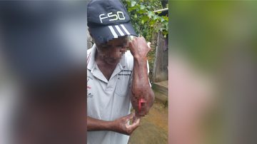 Vítima do atropelamento teve ferimentos no braço esquerdo Filha desabafa após pai ser atropelado por turista em Ubatuba (SP): “não quer ajudar” homem com braço machucado - Foto: Divulgação
