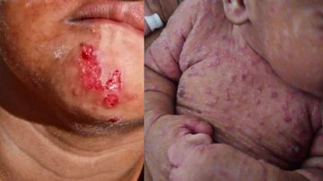 Do lado esquerdo, uma foto recente de uma das crianças acometidas pela doença (2023). Ao lado direito, um bebê infectado pela sarna sumana em 2021 - Reprodução/ edição: Portal Costa Norte