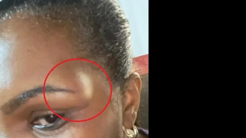 Enfermeira detalha a lesão no supercílio Enfermeira agredida por motorista do Samu Foto mostra o inchaço no supercílio da enfermeira, uma mulher negra - Arquivo pessoal