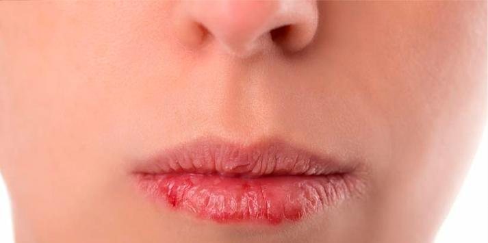 O câncer labial, quando diagnosticado em estágios iniciais, pode ser considerado curável Cancer Labial - Foto: Shutterstock